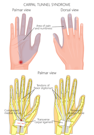 Risks of Carpal Tunnel Release Surgery 1