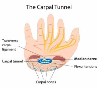Carpal Tunnel 1